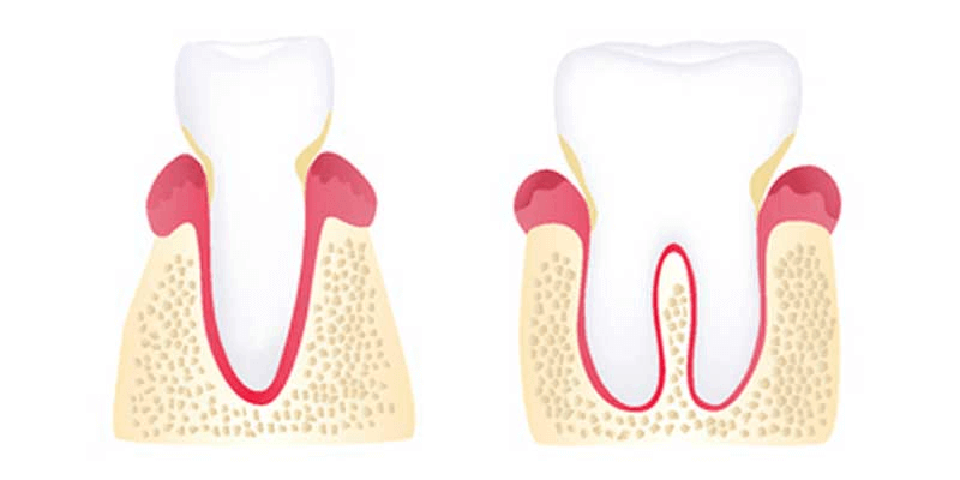 Early Periodontitis Stage