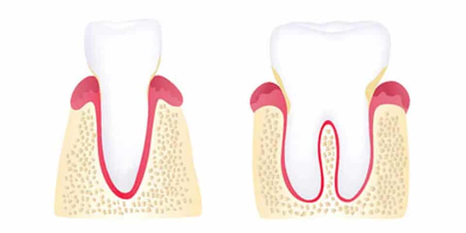 Gingivitis Stage